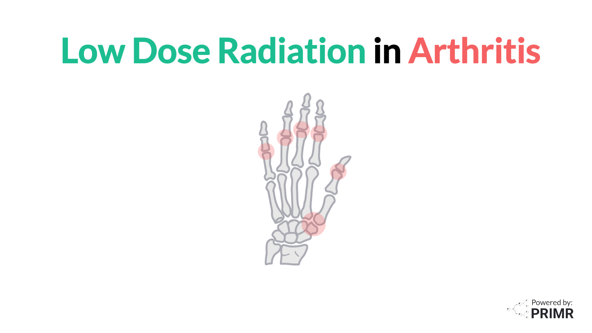 Reviving Low Dose Radiation Therapy For Osteoarthritis PRIMR Reviving low dose radiation therapy for osteoarthritis primr